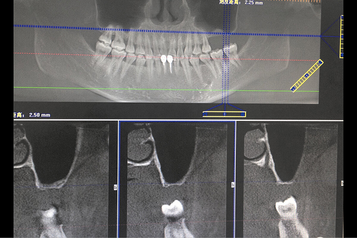 3) 从模型横断面观察到的牙列、牙槽嵴的发育变化-口腔科学-医学